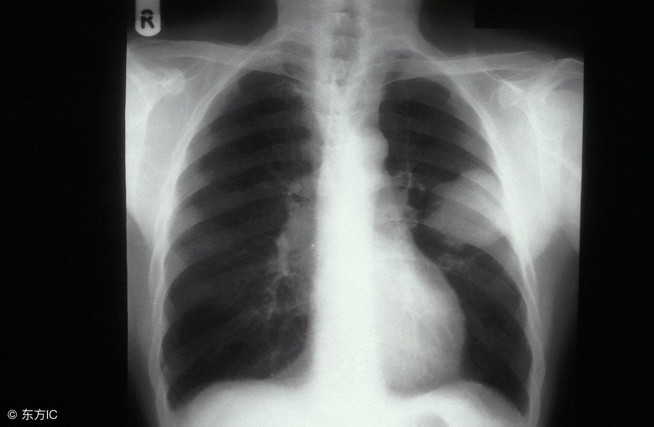 肺癌要知道的10件事,肺癌术后常见并发症和处理方法