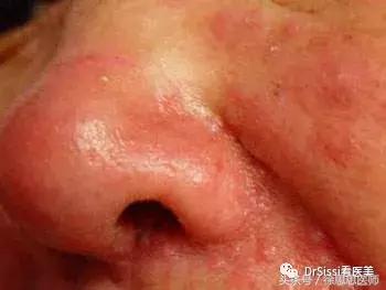 专业去除各种斑痘,专治脸上各种斑各种痘