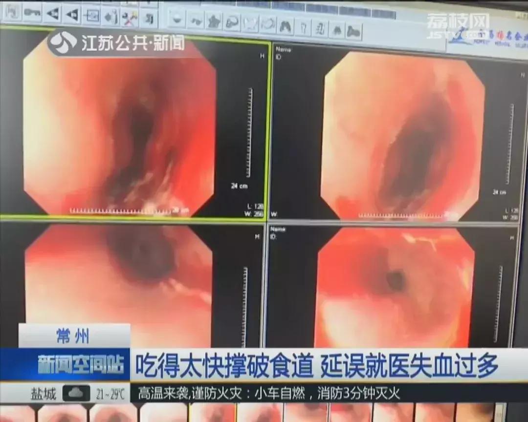 喝水太快撑破食管,女子吃太快撑破食道出血