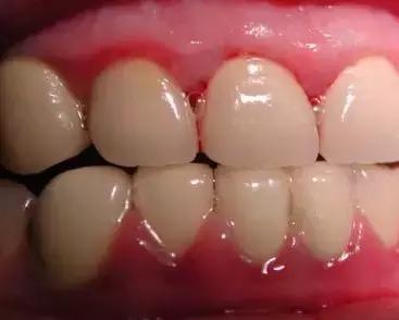 牙龈碰到说不出的难受是怎么回事,牙龈一碰就疼不碰没事是咋回事