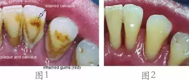 有一个牙齿的牙龈一碰就出血,牙龈萎缩还一碰就出血怎么回事