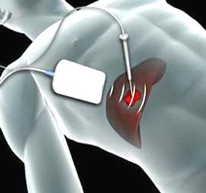 肝脏肿瘤最好的治疗方法是什么,肝脏多发性肿瘤是肝癌能活多久