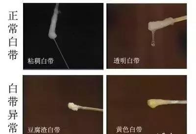 最近感觉内裤老有白带糊状,白带多的裤子都湿了怎么回事