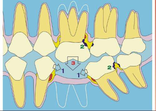 牙缝经常塞东西现在牙有点痛咋办,有牙缝吃东西就塞牙怎么处理好