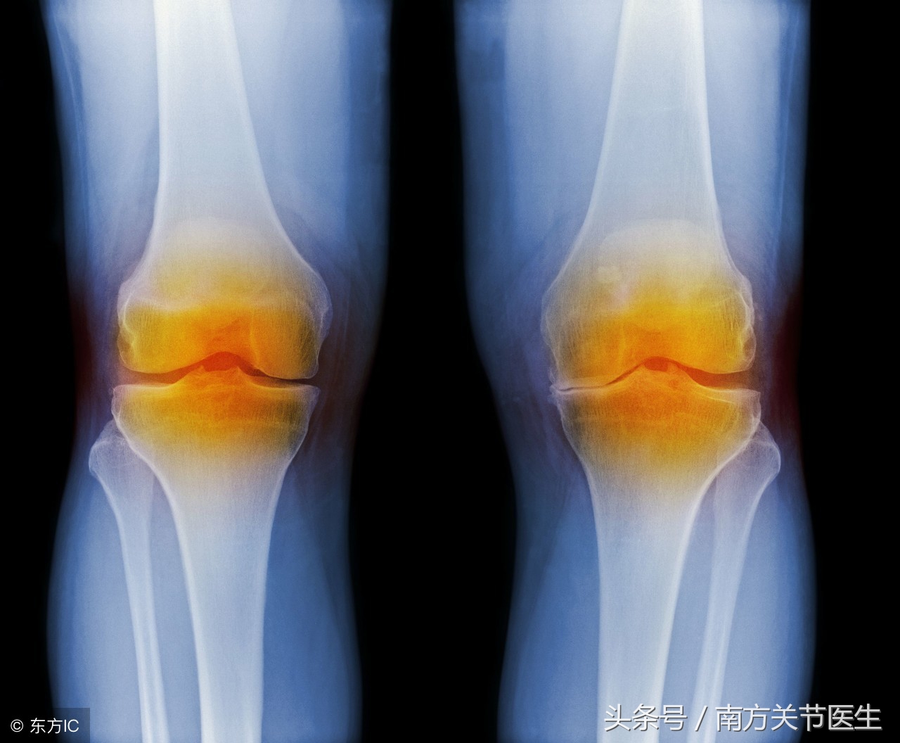 运动后四肢关节酸痛,运动后膝关节发胀酸痛怎么回事