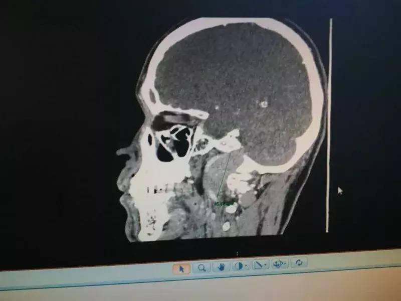脑部肿瘤有鹅蛋那么大能切除吗,脑部病灶变大了怎么回事