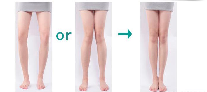 o型腿或x型腿怎么治疗,o型腿xo型腿怎么矫正最有效