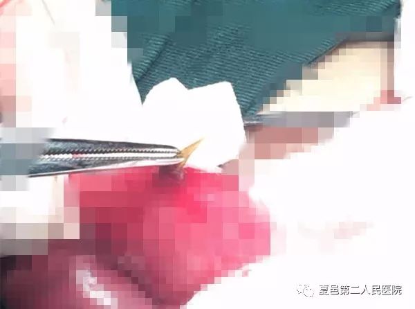 腹部烧灼样疼痛怀疑哪些疾病,腹部疼痛如何排除阑尾炎