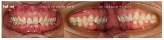 原来，上牙盖住下牙太多，也对牙齿有伤害！该怎么矫正？