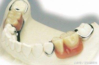 牙根没了镶一颗牙大概多少钱,拔一颗牙再补一颗假牙需要多少钱