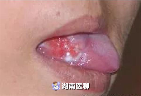 舌头烂了是不是癌症的前兆,舌痛长期不好是舌癌吗