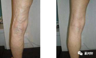 像蚯蚓一样的凸起的纹,像蚯蚓一样黑色的是什么