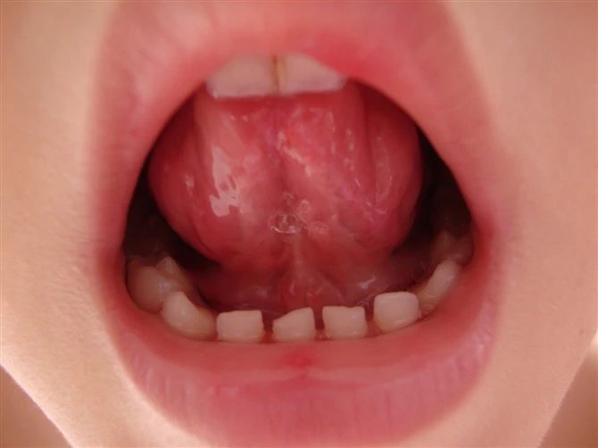 预防手足口病,预防手足口病儿歌