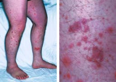 过敏性紫癜紫癜消了脚还痛怎么办,单纯性紫癜与过敏性紫癜怎么区分