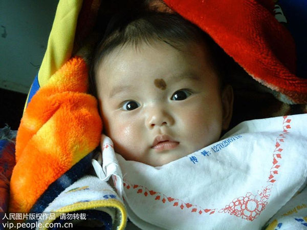 新生儿身上有褐色胎记是什么原因,新生儿头上有黑色胎记是什么原因