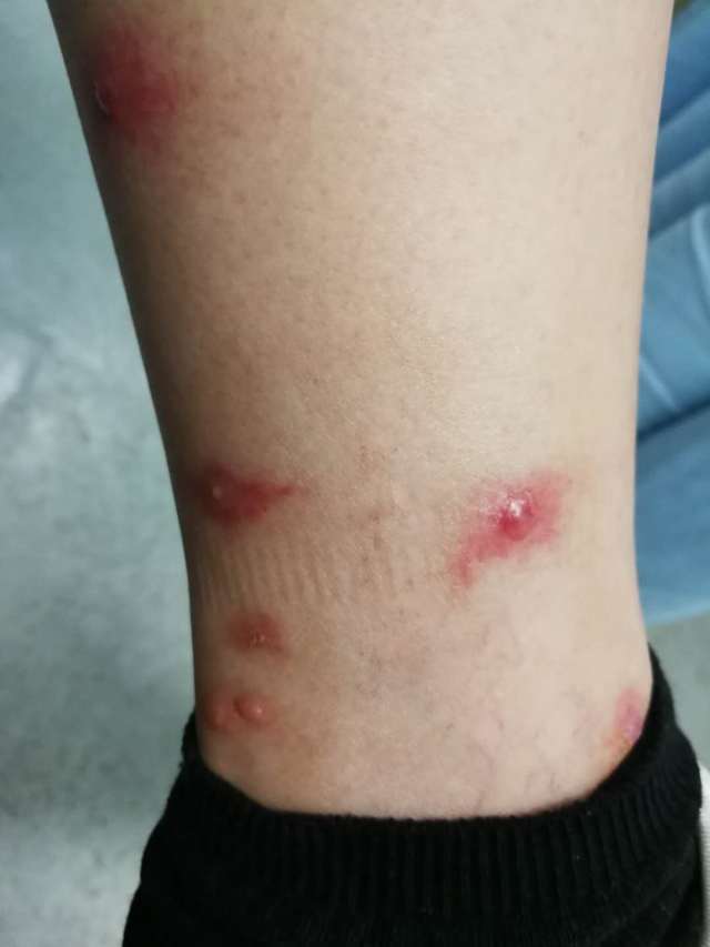 蚊子咬了很大的疙瘩是荨麻疹吗,被蚊子咬后就成荨麻疹