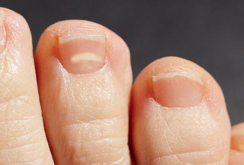 脚趾甲发绿图片,如何判断脚趾甲变色