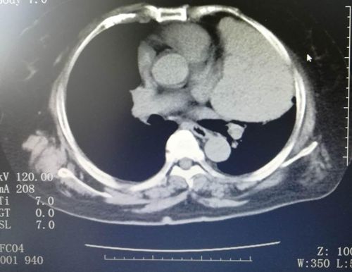 纵隔肿瘤切除后注意事项,纵隔肿瘤较大适合微创吗