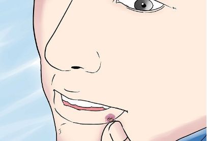 红包有不好的含义吗,额上长疱是什么原因