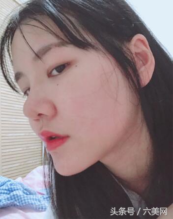 隆鼻后如何克服焦虑,隆鼻后前三天状态