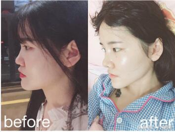 隆鼻后如何克服焦虑,隆鼻后前三天状态