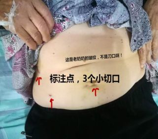 以为是肠胃小毛病没想到是癌症,开始以为是胃疼后来才发现是结石