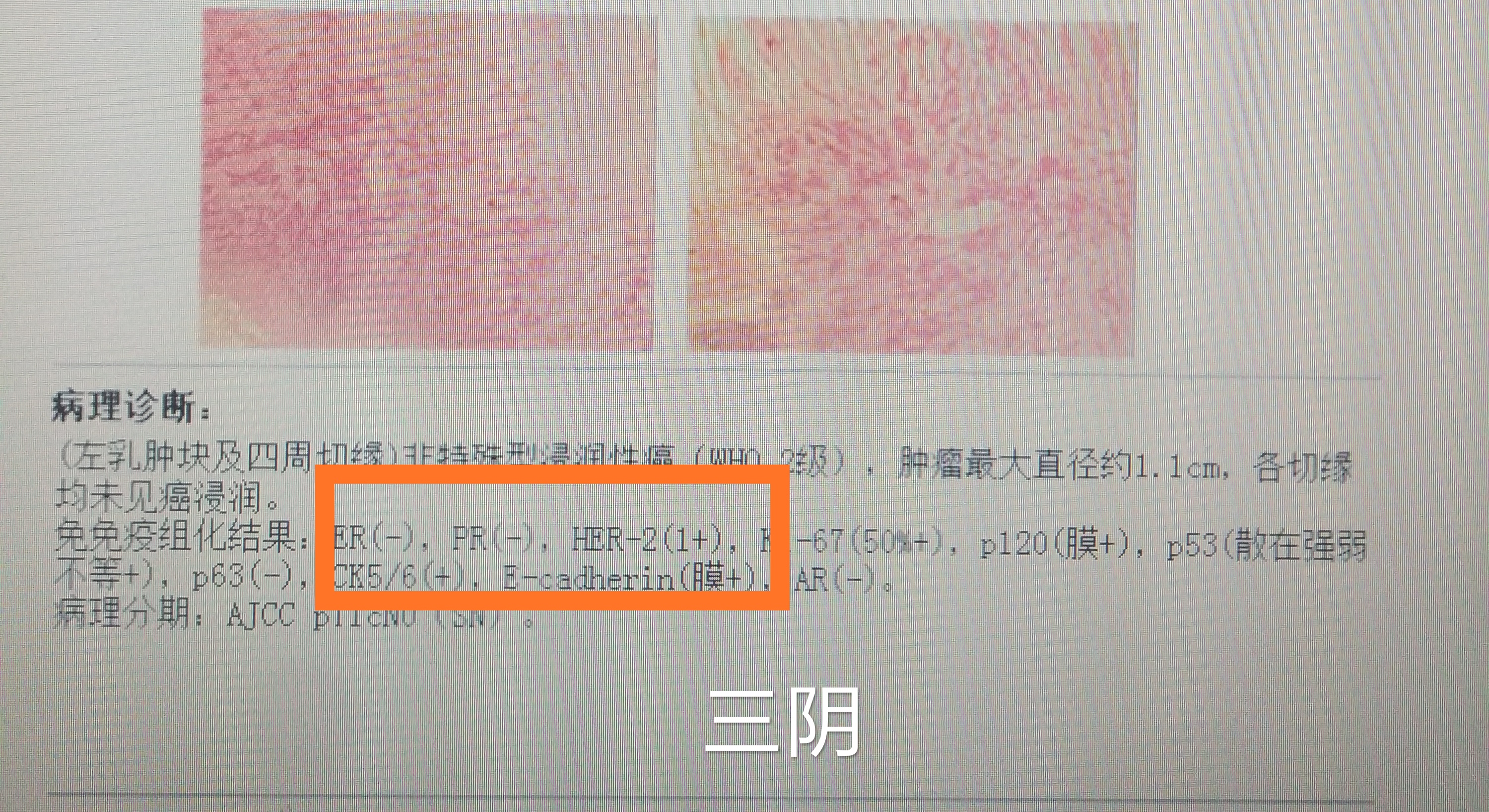 乳腺癌三阴一阳意味着什么,什么是两阳一阴乳腺癌