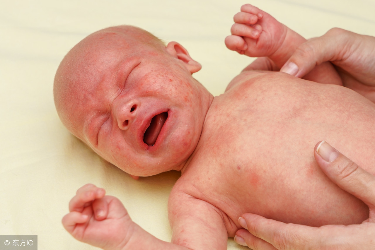 宝宝起湿疹最快的解决方法,婴儿长了湿疹用什么药膏