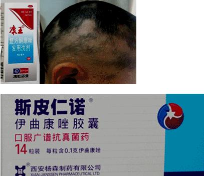 皮肤真菌感染诊断结果,皮肤真菌感染治疗方法