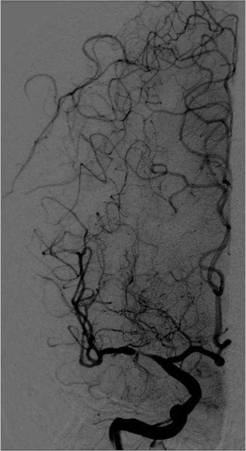 天坛周记｜右大脑中动脉重度狭窄血管内介入治疗1例