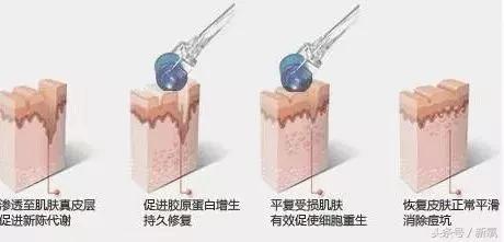 治疗痘坑的微针品牌,家用抗皱美白祛斑微针