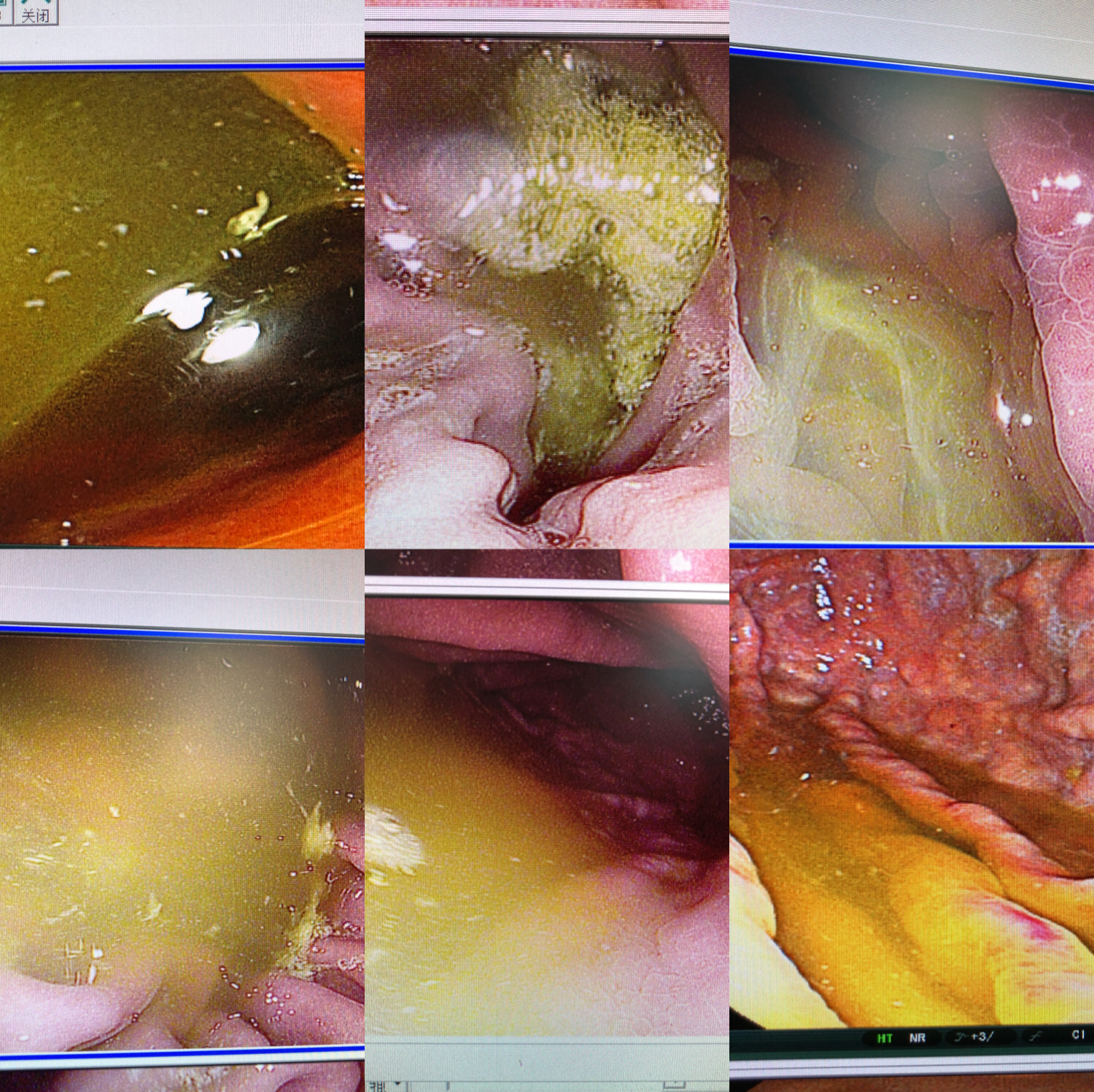 黄色的胆汁吐出来了怎么办,胆汁反流入胃呕吐物什么色