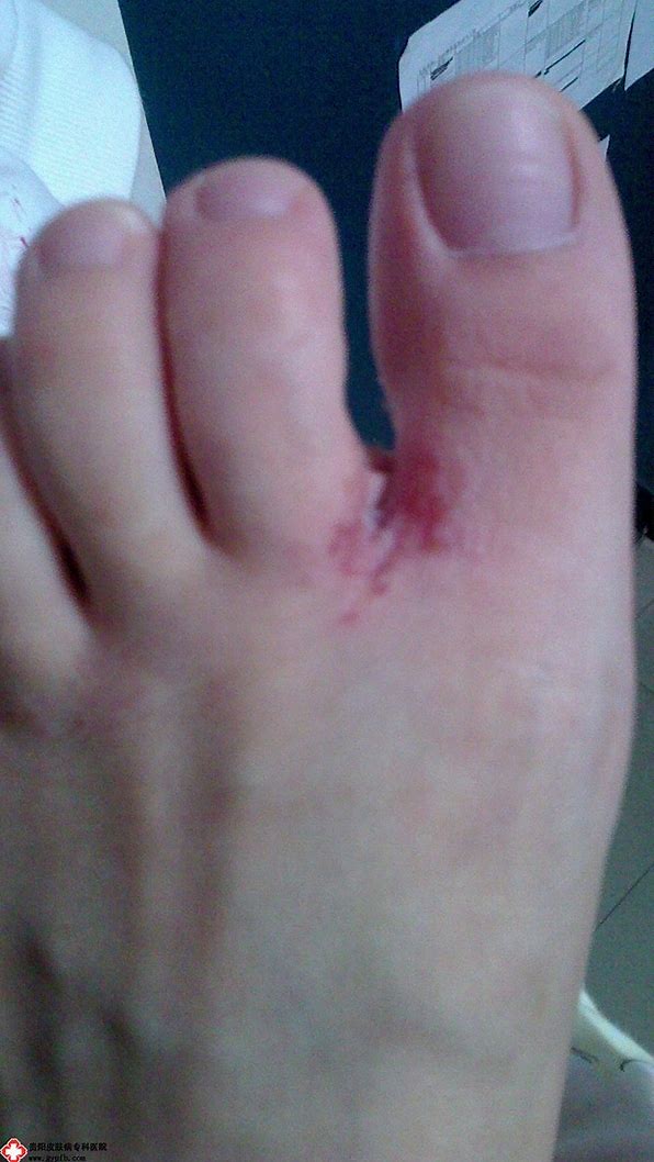 脚气引起皮质增厚怎么用药,脚气用碘伏之后可以用药吗