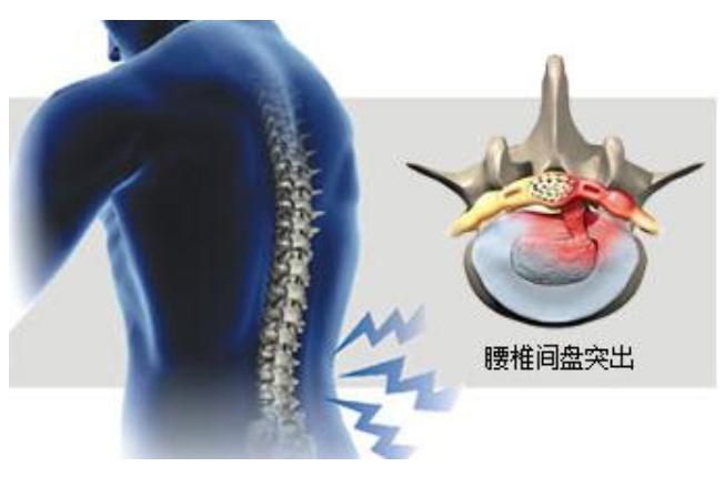 腰椎间盘突出因受寒引起腰腿疼痛,治疗腰椎间盘突出腰腿疼的方法