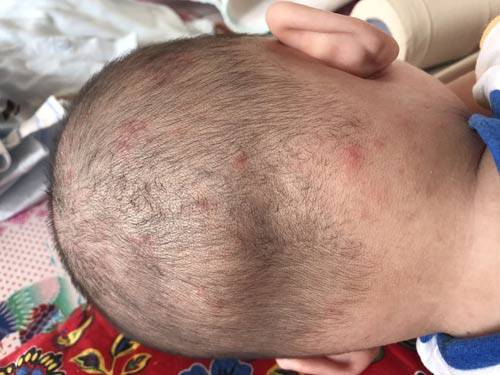 宝妈容易长痱子,宝妈长痱子