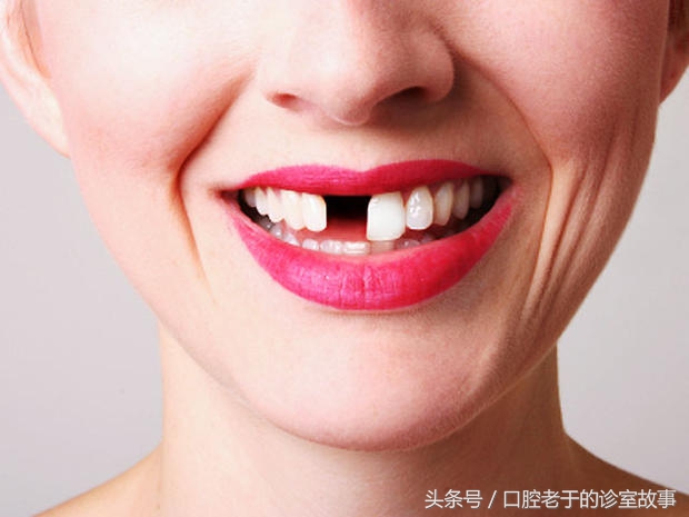 缺一颗牙种植好还是搭桥好,23岁下一排牙缺四颗可以矫正吗