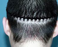 种植头发价格是多少合适,头发种植价格一般多少钱