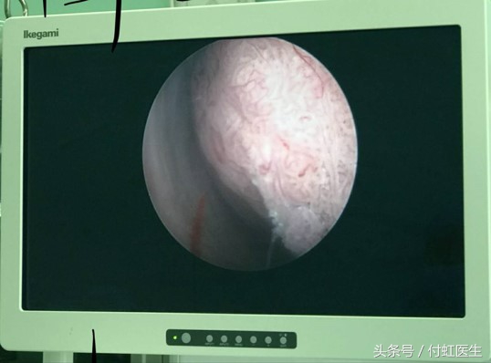 血性白带是宫颈癌吗,血性白带是癌的可能性大吗