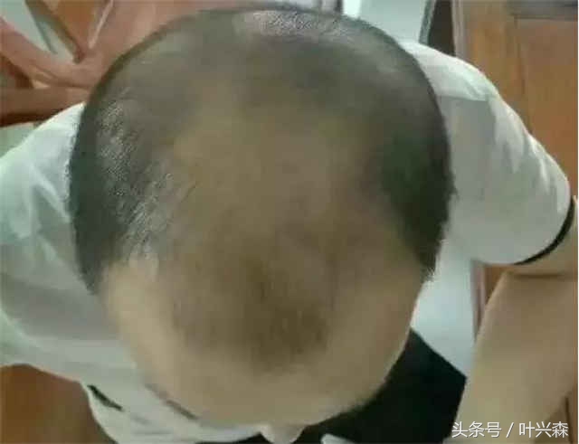 脱发掉发秃顶你该了解生发方法了,秃顶脱发最好的治疗方法