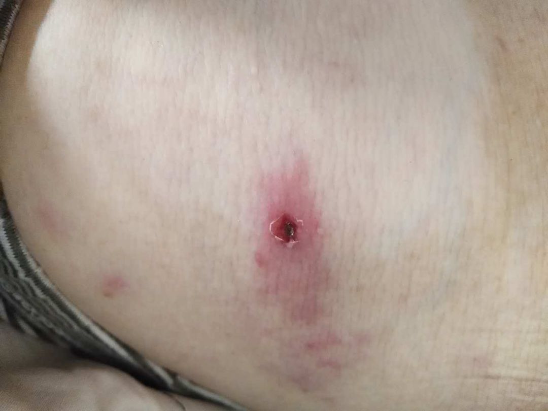 小小虫咬伤，伤害那么大！