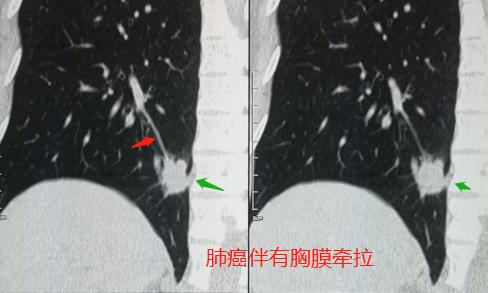 肺癌脑部转移还有脑血栓,脑梗查出肺结节怀疑肺癌