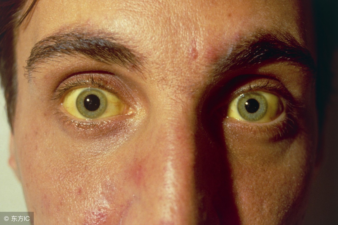 甲肝和乙肝怎么引起的,甲肝是怎么回事