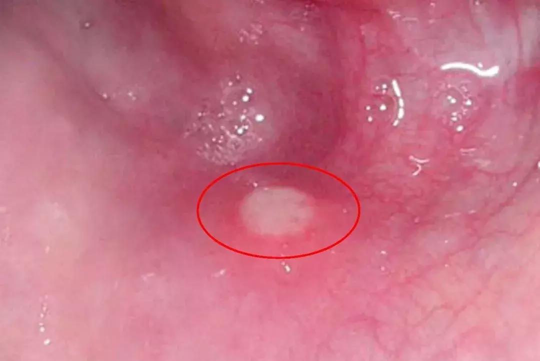 疱疹性咽峡炎身上会起疹子吗,幼儿园疱疹性咽峡炎停课标准