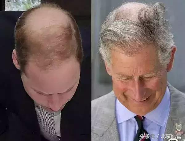 每5名男士就有一人中招？快帮爸爸解决这件“头顶大事”！