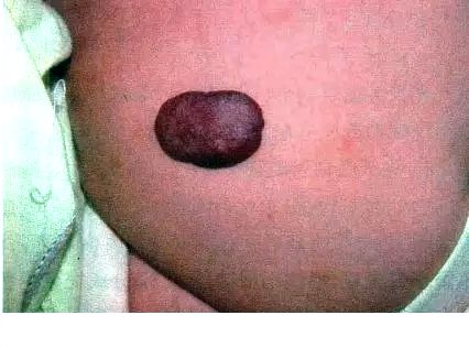 宝宝出生有青色胎记是怎么回事,宝宝出生有绿色胎记怎么办