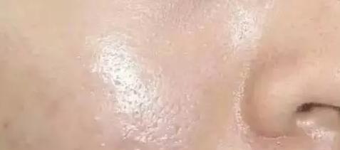 毛孔变粗大了怎么修复,毛孔稍微变大怎么办小妙招