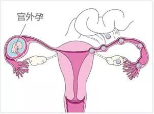 妇幼医生谈宫外孕,关于宫外孕的科普知识