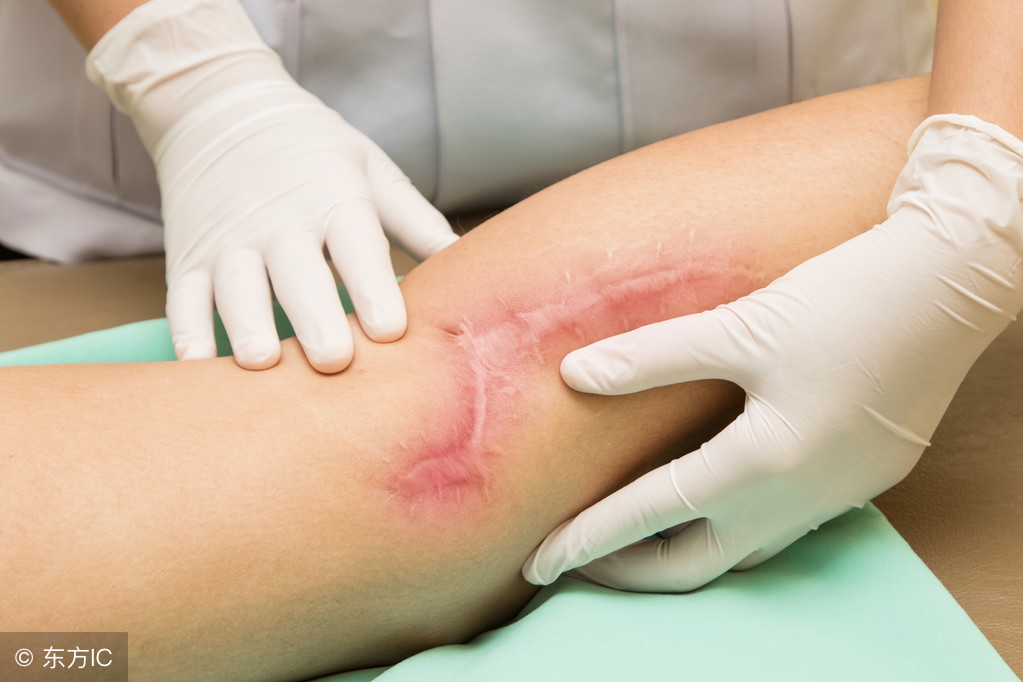 受伤后如何护理才能避免留疤,刚受伤的伤口如何预防留下疤痕