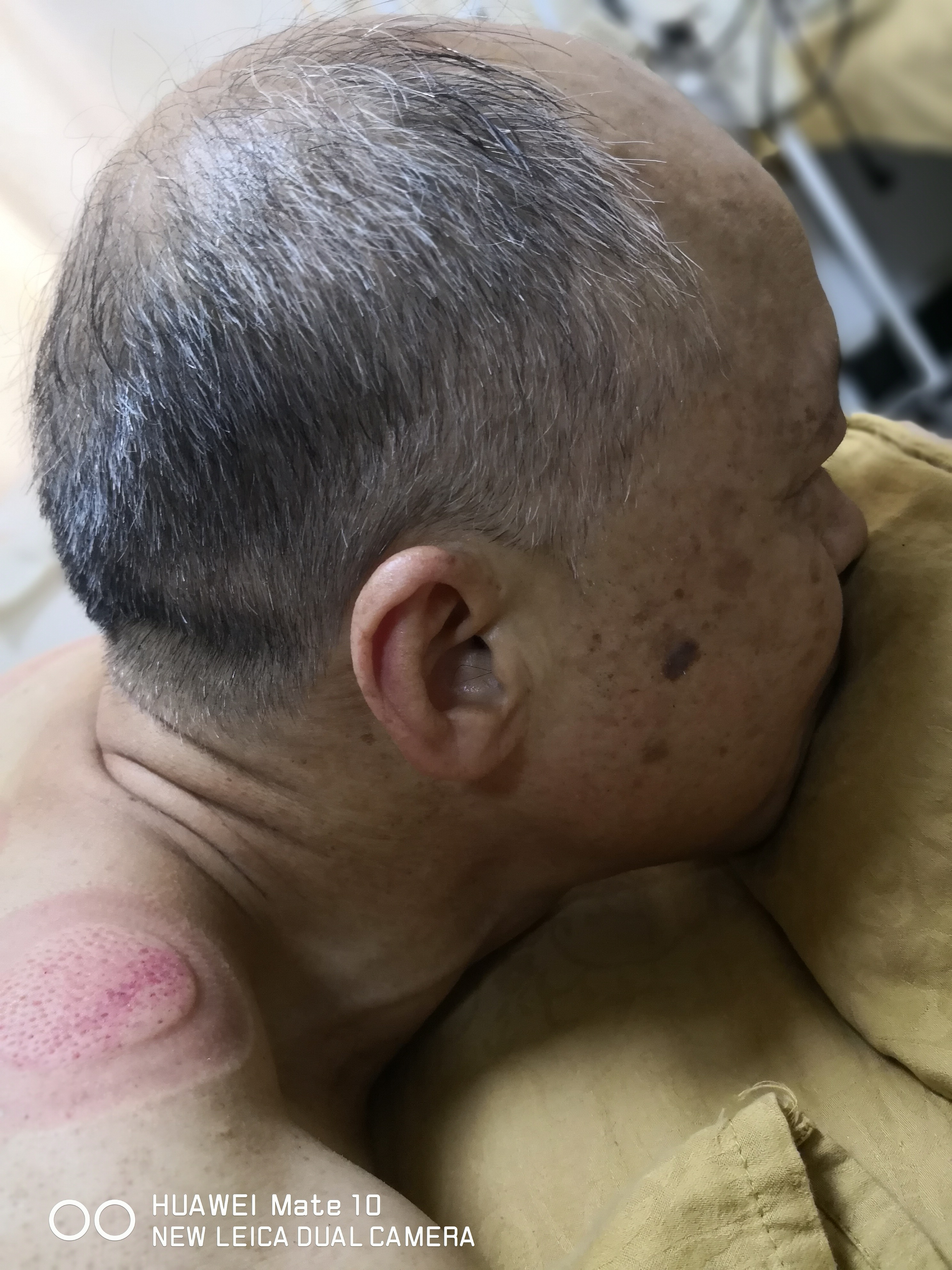 股骨头坏死二期置换好吗,遗传型脱发白发