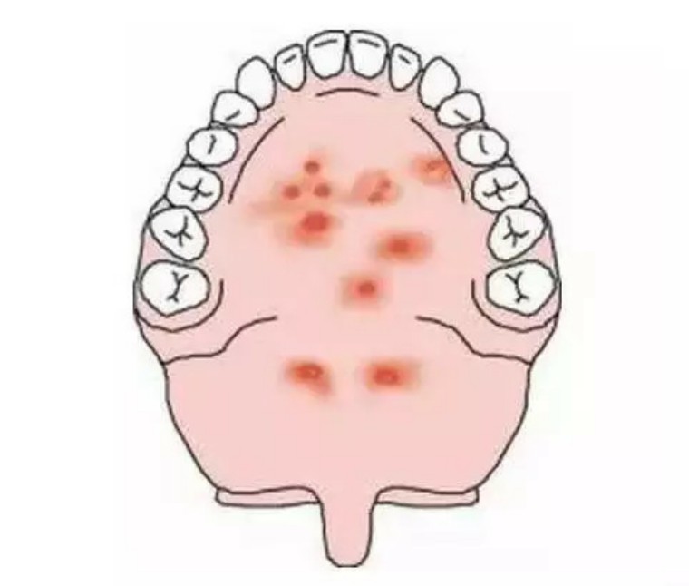 疱疹性咽峡炎怎么治疗最好,疱疹性咽峡炎是如何引起的